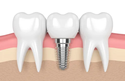 dental implants mascot